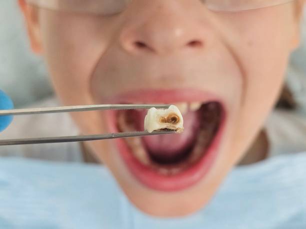 Best Broken or Cracked Tooth Emergency Dentist in Islandia, NY